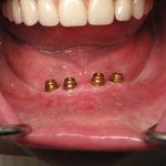 Denture Implant A Permanent Solution for Missing Teeth denture implant