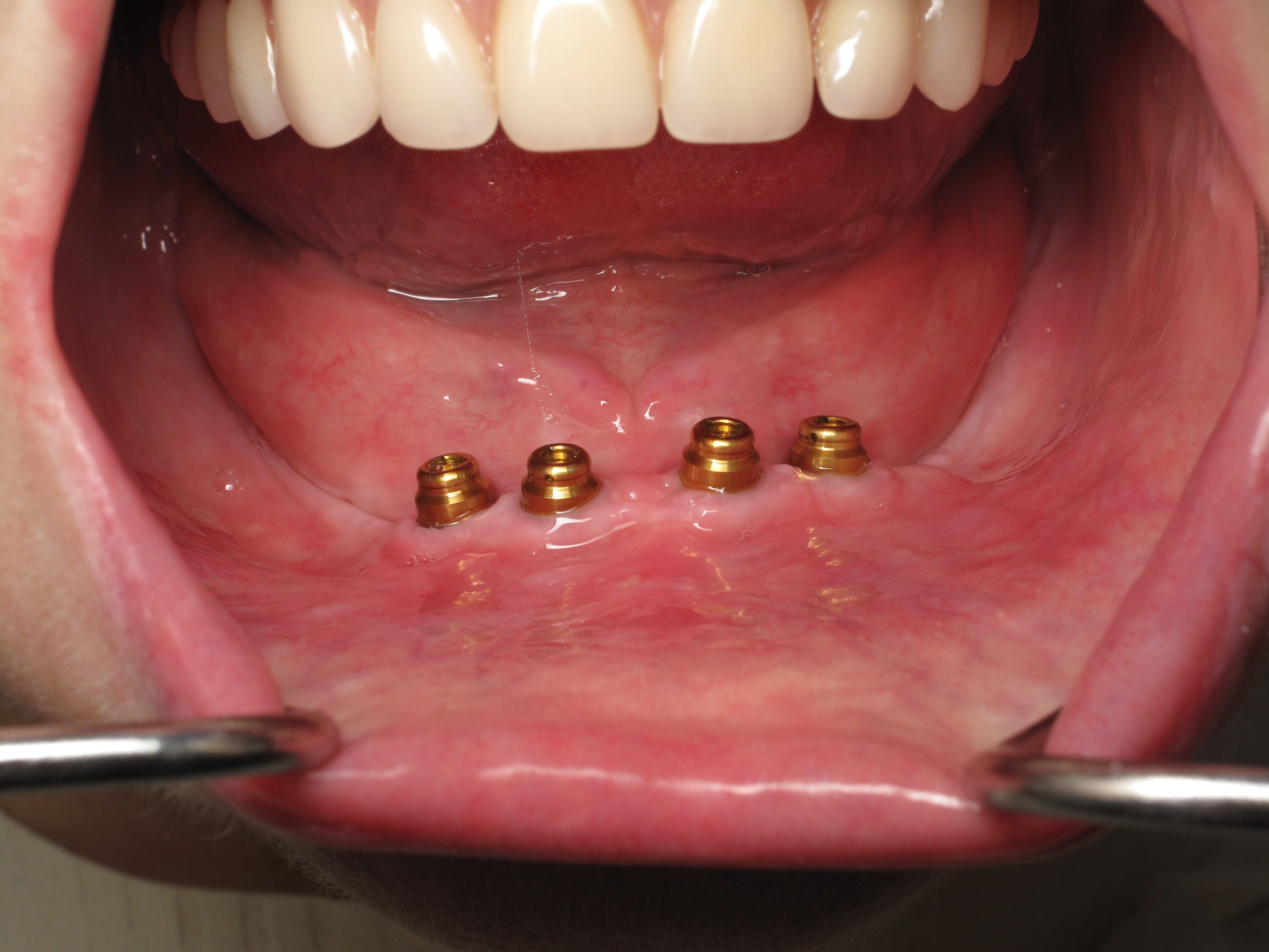 denture implant
