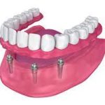 Revitalize Your Smile with Denture Implants denture implants