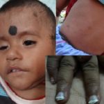 Diamond Blackfan Anemia the Rare Blood Disorder diamond blackfan anemia