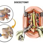 Exploring the Healing Path: All About Discectomy Surgery discectomy