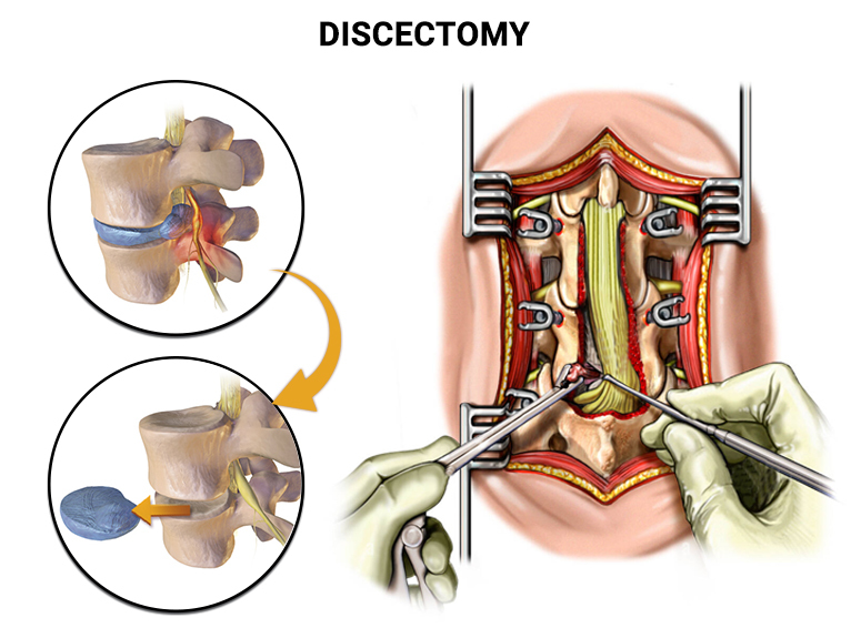 discectomy