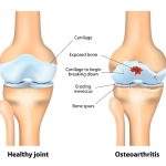 DJD (Degenerative Joint Disease) Causes, Symptoms, and Management djd