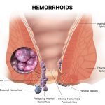 Do Hemorrhoids Go Away on Their Own Hemorrhoid Relief do hemorrhoids go away on their own