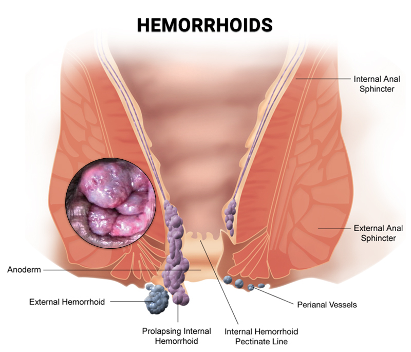 do hemorrhoids go away on their own