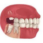 Wisdom Teeth: Do They Really Appear in Everyone? does everyone have wisdom teeth