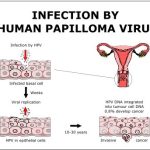 Does HPV Go Away The Lifecycle of Human Papillomavirus does hpv go away