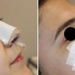 Doyle Splints: A Solution for Sleep Apnea and More doyle splints removal