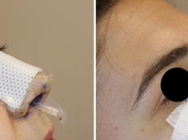 doyle splints removal