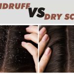 Dry Scalp vs. Dandruff The Itchy Dilemma dry scalp vs dandruff