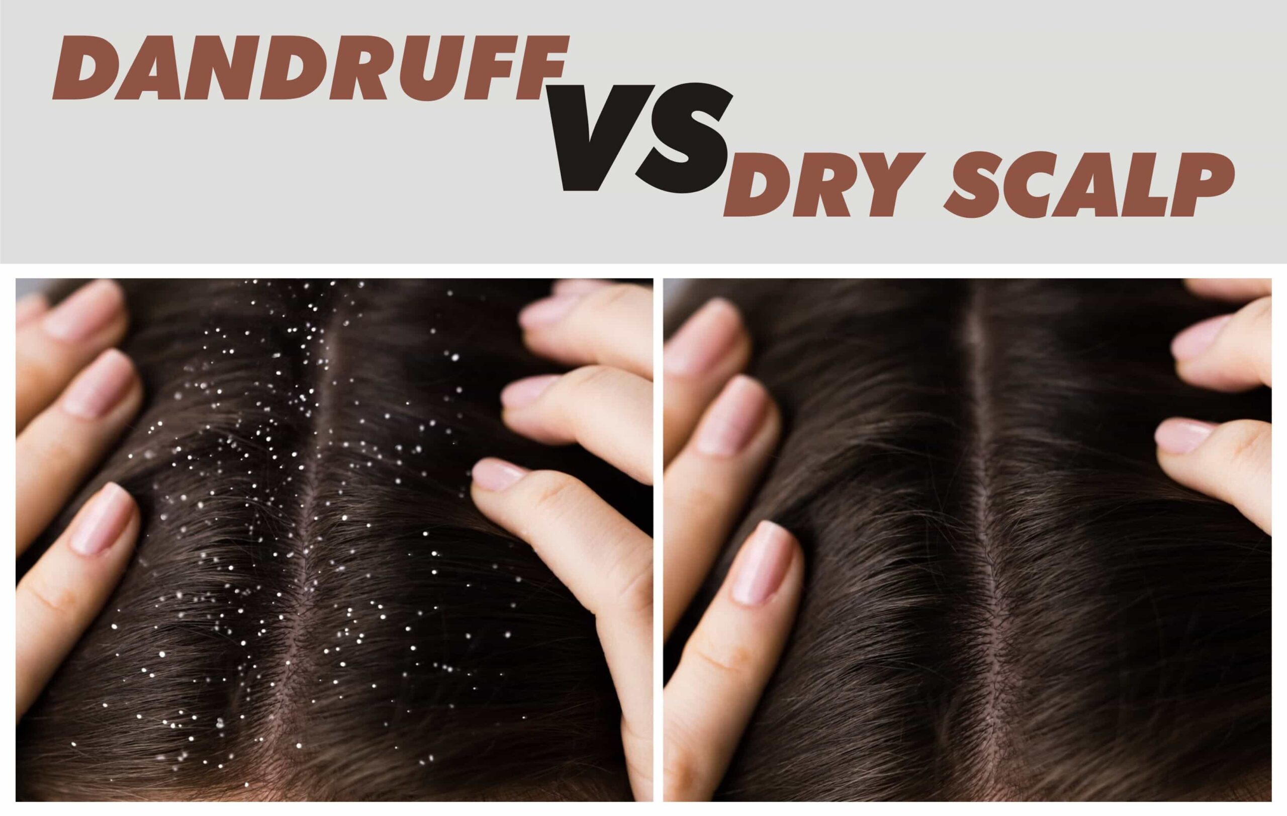 dry scalp vs dandruff
