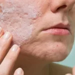 Epiduo Forte: A Breakthrough in Acne Treatment epiduo forte