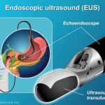 The Potential of EUS Endoscopic Ultrasound in Medical Imaging eus