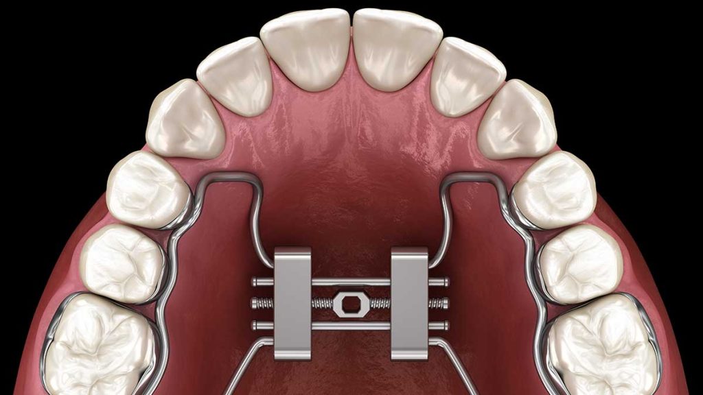 expander teeth