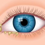 Dealing with Eye Discharge: Causes, Symptoms, and Care eye discharge