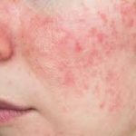 Finacea:The Power of This Topical Gel for Clearer and Healthier Skin finacea