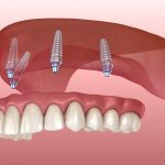 Smile Confidently with Fixed Dentures: The Ultimate Dental Restoration fixed dentures