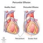 Pericardial Effusion: Fluid Around the Heart fluid around the heart