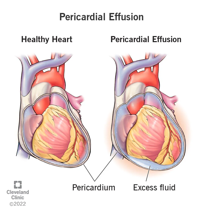 Pericardial Effusion Fluid Around the Heart