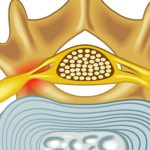 Demystifying Foraminal Narrowing: Causes, Symptoms, and Relief foraminal narrowing