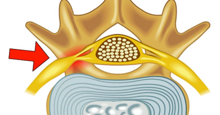 Formane Rasgado Demystifying Foraminal Narrowing: Causes, Symptoms, and Relief