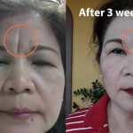 Treating Frown Lines A Comprehensive Guide frown lines