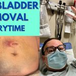 Gallbladder Surgery Recovery Tips for a Speedy Healing Journey gallbladder surgery recovery