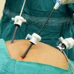 Gallbladder Surgery Recovery Time What to Expect gallbladder surgery recovery time