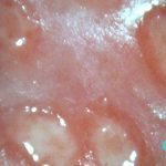 Genital Sores Causes, Symptoms, and Treatment genital sores