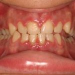Gingival Hyperplasia Causes, Symptoms, and Treatment gingival hyperplasia