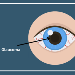 Navigating Glaucoma Surgery: A Comprehensive Guide glaucoma surgery