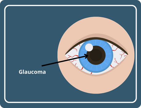 glaucoma surgery