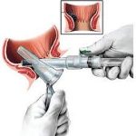 Hemorrhoid Banding Relief and Recovery hemorrhoid banding