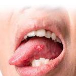 Herpes on Tongue: Causes, Symptoms, and Effective Remedies herpes on tongue