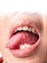 herpes on tongue