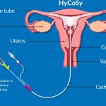 Histerosalping: Understanding the Procedure and Its Benefits histerosalping