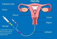 Histerosalping: Understanding the Procedure and Its Benefits histerosalping