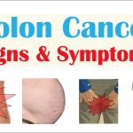 My Journey How I Knew I Had Colon Cancer how i knew i had colon cancer