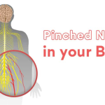 Demystifying Pinched Nerves: How Long Does a Pinched Nerve Last? how long does a pinched nerve last