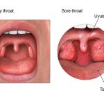 Dealing with a Sore Throat How Long Does It Linger how long does a sore throat last