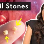 Effortless Solutions How to Get Tonsil Stones Out how to get tonsil stones out