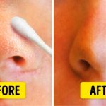 Clearing the Path How to Remove Blackheads from Nose Effectively how to remove blackheads from nose