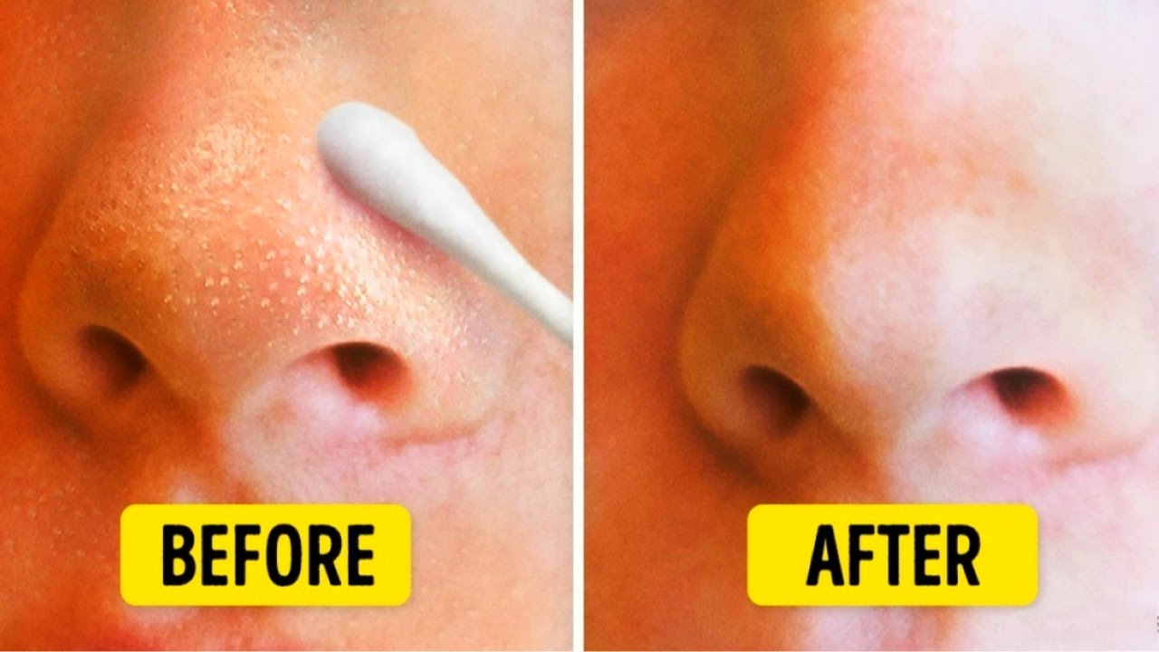 how to remove blackheads from nose