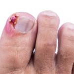 A Step-by-Step Guide How to Remove Ingrown Toenail for Quick Relief how to remove ingrown toenail