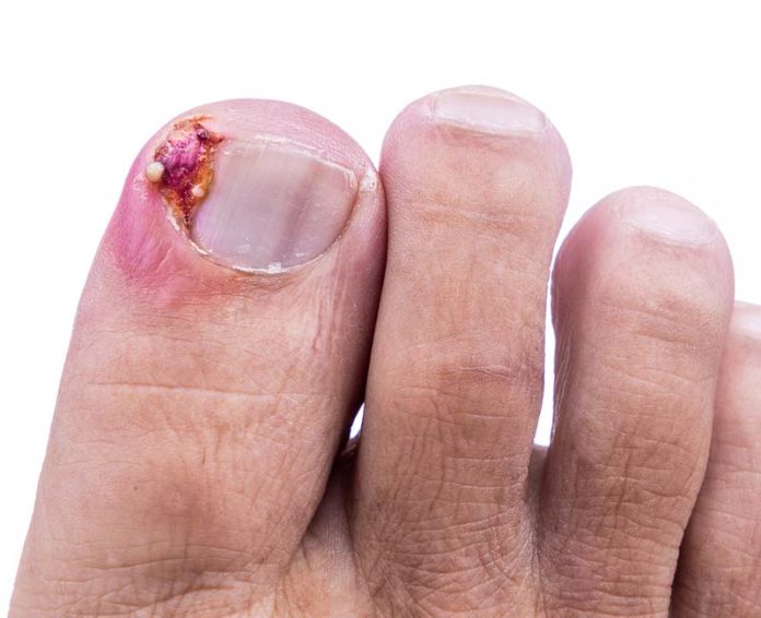 a-podiatrist-s-treatment-for-an-ingrown-toenails