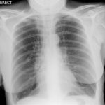 Hyperinflation of Lungs: Causes, Symptoms, and Treatment hyperinflation of lungs