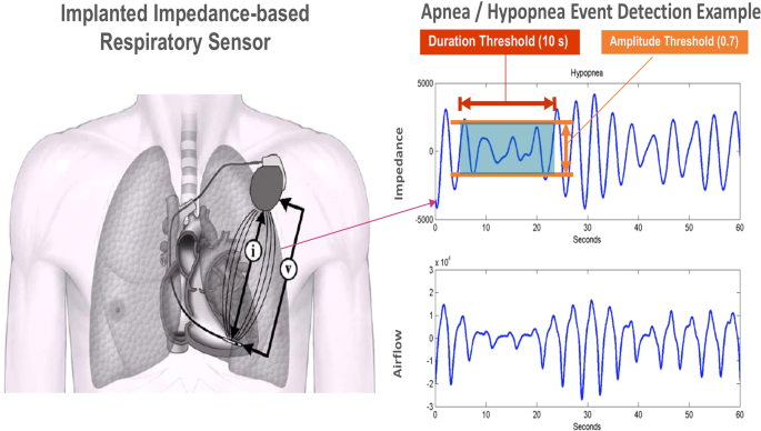 hypopneas