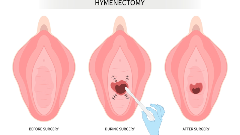 imperforate hymen