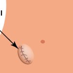 Incisional Hernia Causes, Symptoms, and Treatment incisional hernia