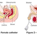 Navigating Life with an Indwelling Catheter: Tips and Insights indwelling catheter